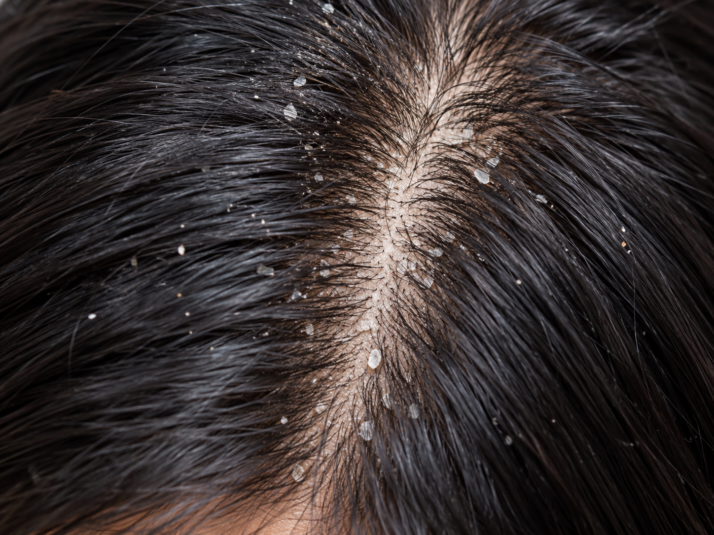 Anti-dandruff care